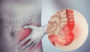 Cyrex Array 22 - Irritable Bowel / SIBO Screen (Includes Doctor's Consultation on All Test Findings)