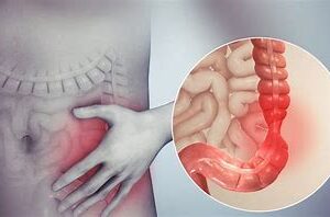Cyrex Array 22 - Irritable Bowel / SIBO Screen (Includes Doctor's Consultation on All Test Findings)
